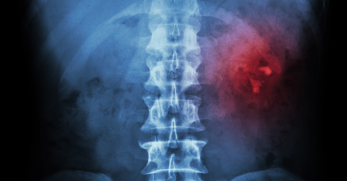 Estimulação Elétrica Transcutânea Parassacral e Percutânea no